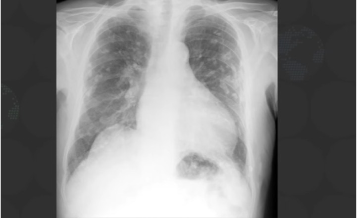 What Happens If You Disturb Asbestos