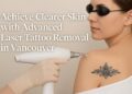 Achieve Clearer Skin with Advanced Laser Tattoo Removal in Vancouver